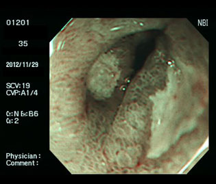 胃・十二指腸潰瘍（30代女性）・ピロリ菌陽性の狭帯域光（NBI）画像