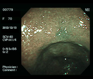 ピロリ除菌治療2か月後、潰瘍は瘢痕化し、発赤を残すのみとなっている狭帯域光（NBI）画像