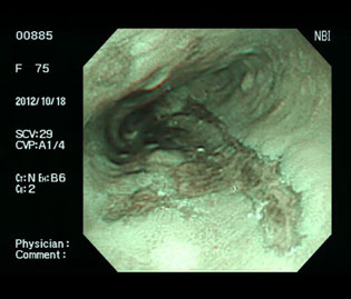 食道中部の食道潰瘍（70代女性）の狭帯域光（NBI）画像