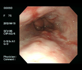 食道下部の逆流性食道炎（70代女性）の通常光画像