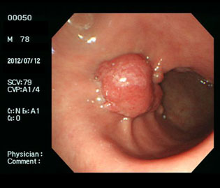 過形成性ポリープ（70代男性）・ピロリ菌陽性の通常光画像
