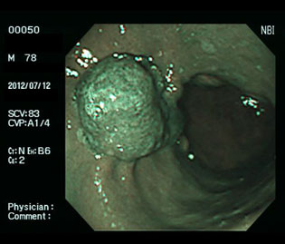 過形成性ポリープ（70代男性）・ピロリ菌陽性の狭帯域光（NBI）画像