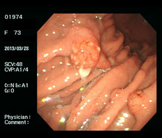 過形成性ポリープ（60代女性）・ピロリ菌陽性の通常光画像