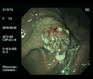 過形成性ポリープ（60代女性）・ピロリ菌陽性の狭帯域光（NBI）画像
