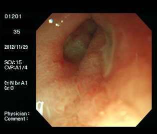 胃・十二指腸潰瘍（30代女性）・ピロリ菌陽性の通常光画像