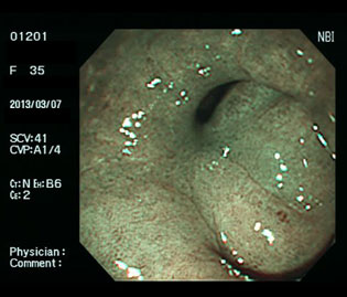 ピロリ除菌治療3か月後、潰瘍は瘢痕化し、治癒している狭帯域光（NBI）画像