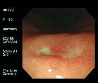 胃潰瘍（70代女性）・ピロリ菌陽性の通常光画像