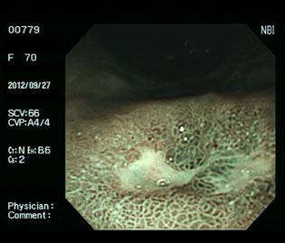 胃潰瘍（70代女性）・ピロリ菌陽性の狭帯域光（NBI）画像