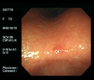 ピロリ除菌治療2か月後、潰瘍は瘢痕化し、発赤を残すのみとなっている通常光画像
