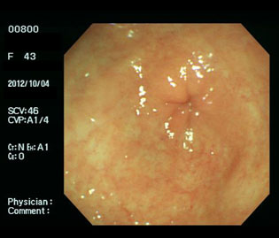 胃前庭部の萎縮性胃炎（50代女性）の通常光画像