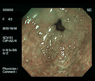 胃前庭部の萎縮性胃炎（50代女性）の狭帯域光（NBI）画像