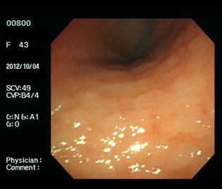 萎縮性胃炎に出現した腸上皮化生（多発する白色隆起）・ピロリ菌陽性の通常光画像