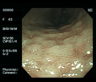 萎縮性胃炎に出現した腸上皮化生（多発する白色隆起）・ピロリ菌陽性の狭帯域光（NBI）画像