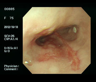 食道中部の食道潰瘍（70代女性）の通常光画像