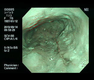内服治療2か月後食道潰瘍は改善し、疼痛は消失した狭帯域光（NBI）画像