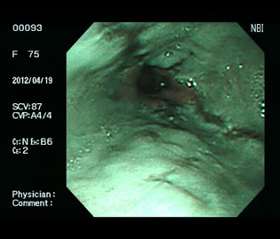 食道下部の逆流性食道炎（70代女性）の狭帯域光（NBI）画像