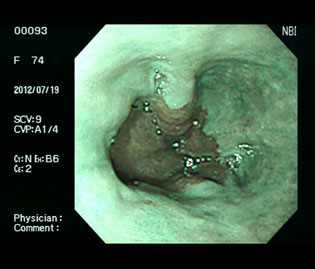内服治療2か月後胸やけは消失し無症状となった狭帯域光（NBI）画像