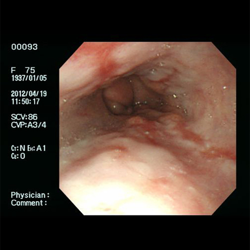 逆流性食道炎 - 通常光による食道の観察像例