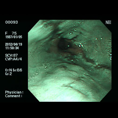 逆流性食道炎 - NBIによる食道の観察像例