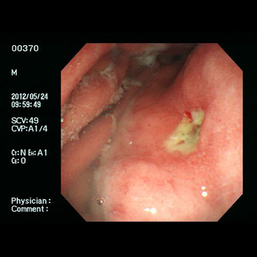 胃潰瘍・十二指腸潰瘍 - 通常光による食道の観察像例