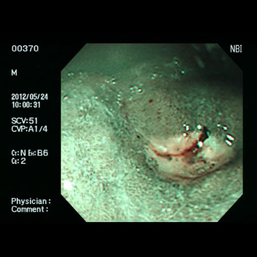 胃潰瘍・十二指腸潰瘍 - NBIによる胃潰瘍の観察像例
