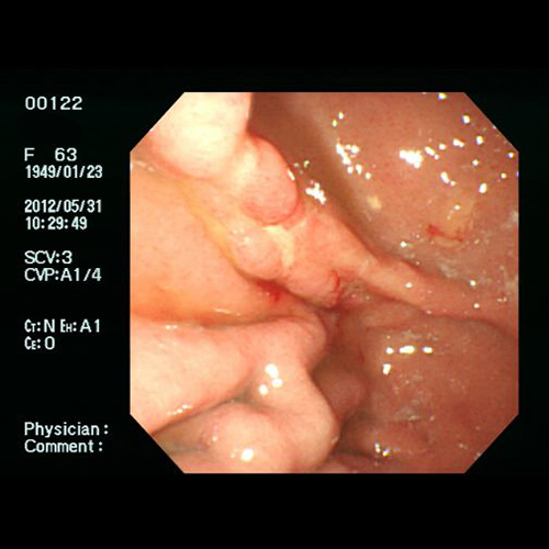 通常光による胃がんの観察像例