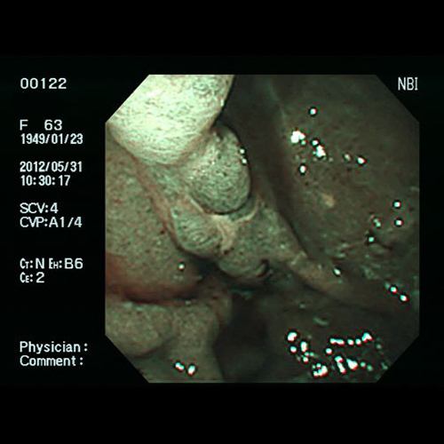 NBIによる胃がんの観察像例